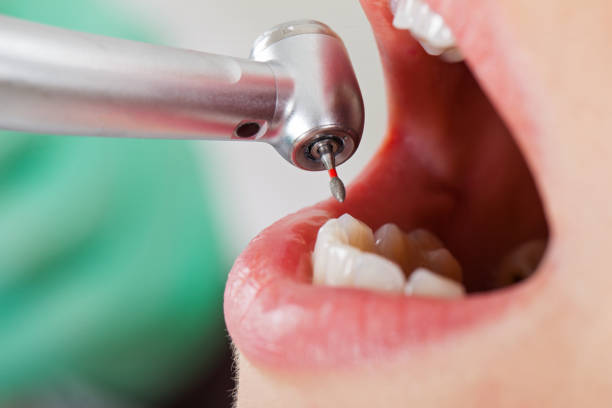 Best Broken or Chipped Tooth Repair in Helena Valley Northeast, MT